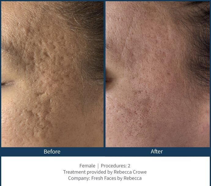 BA-SkinPen-Acne_FreshFaces_RebeccaCrow-1_scale_100_quality_100_embedMetadata_true_contentETag_2_embedColorProfile_true