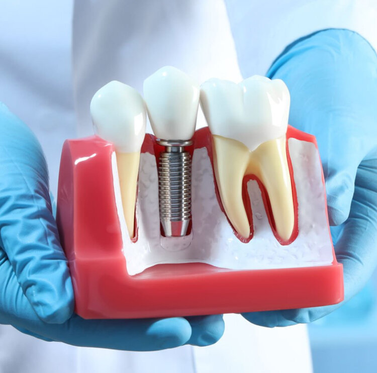 Single Tooth Implant in Lakeway, TX