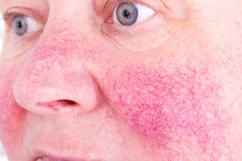 close up image of older woman's rosacea cheeks and nose
