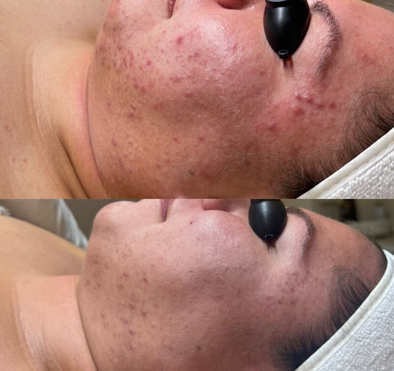 Acne Before and After Results