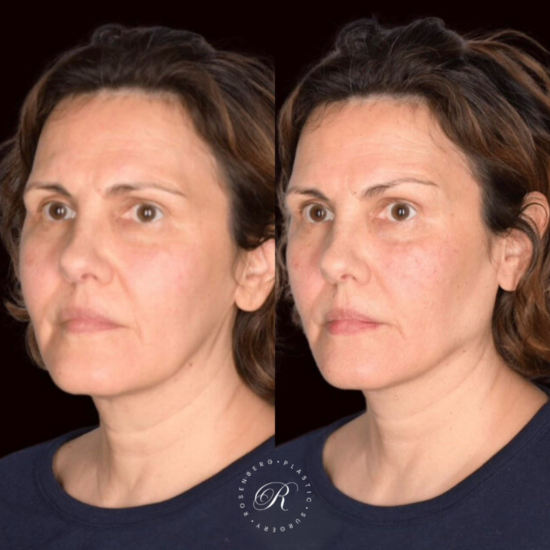 Non-surgical Cheek Augmentation RPS Before & After.zip - 3