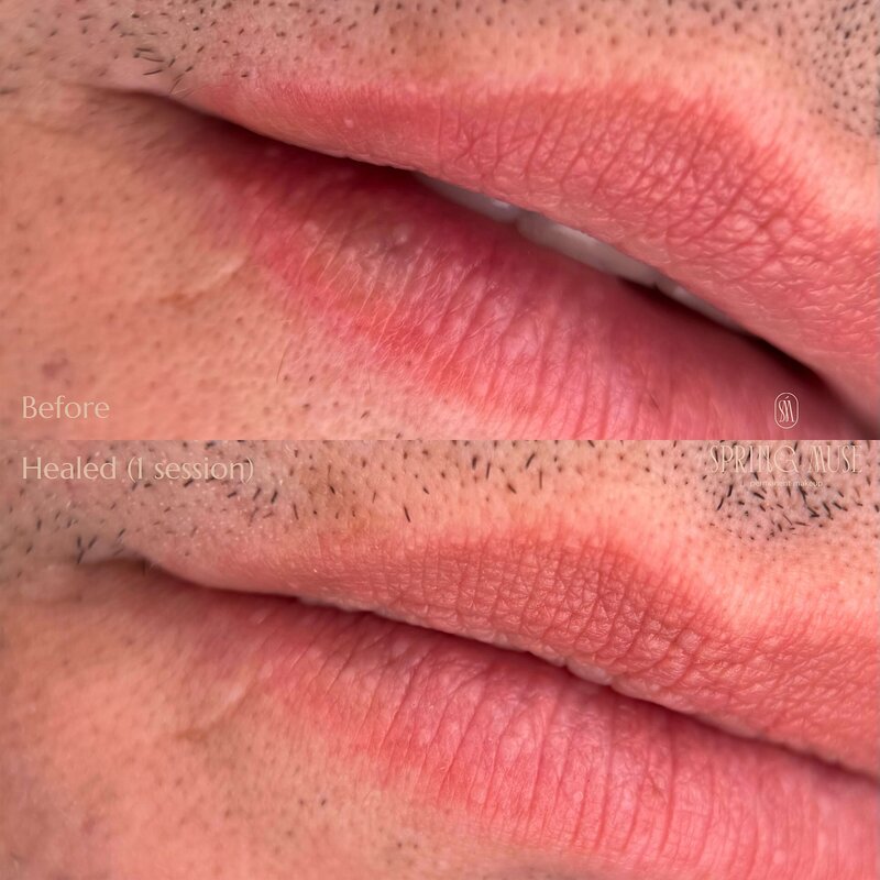 Alkaline Tattoo removal