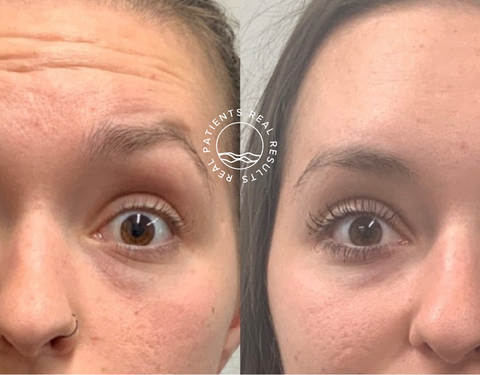 Botox (3)
