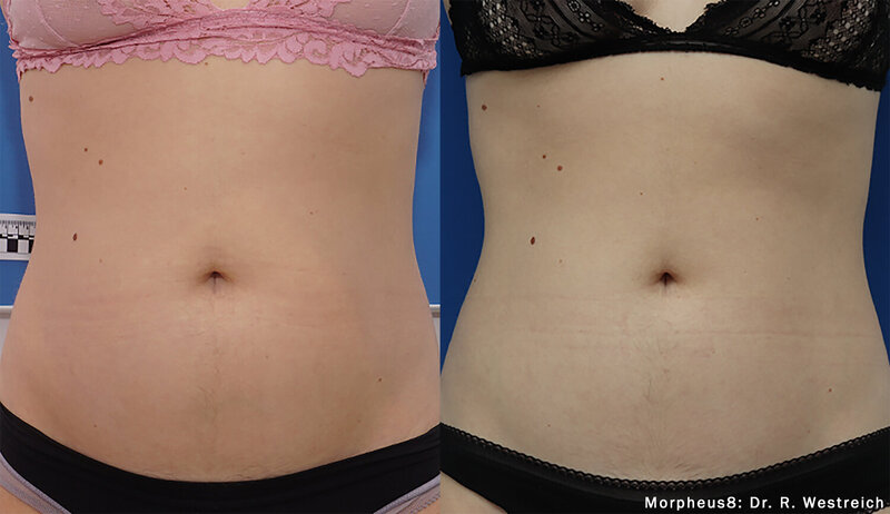 Morpheus8_Abdomen_RWestreich