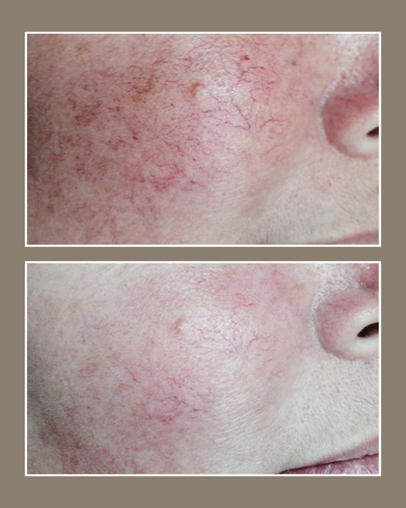 Lumecca IPL - Glösense Dermatology