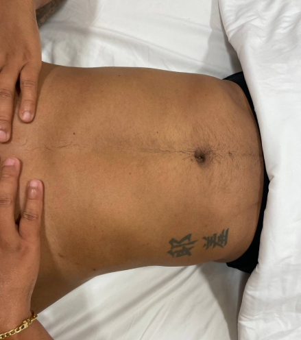 Before a client received a full body lymphatic drainage massage