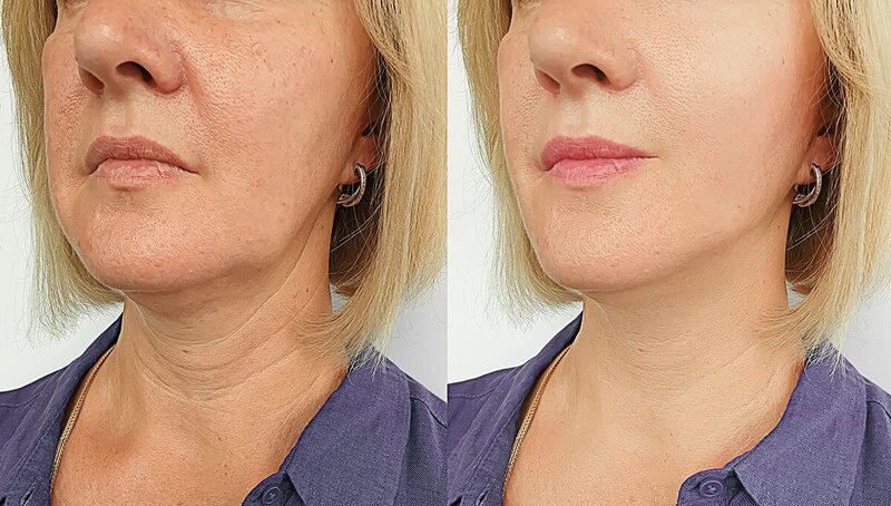 Botox-And-Fillers-Before-After-scaled-1