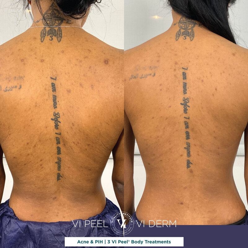 D. Parkes_4 VI Peel Body_Back Acne_RATING B