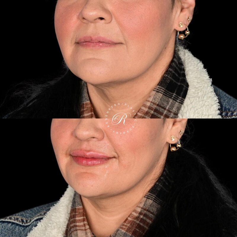 Non-surgical Lip Augmentation RPS Before & Afters.zip - 4