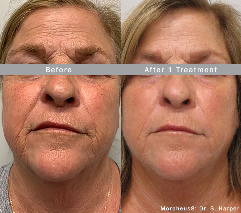 Morpheus8_Before&After (4)