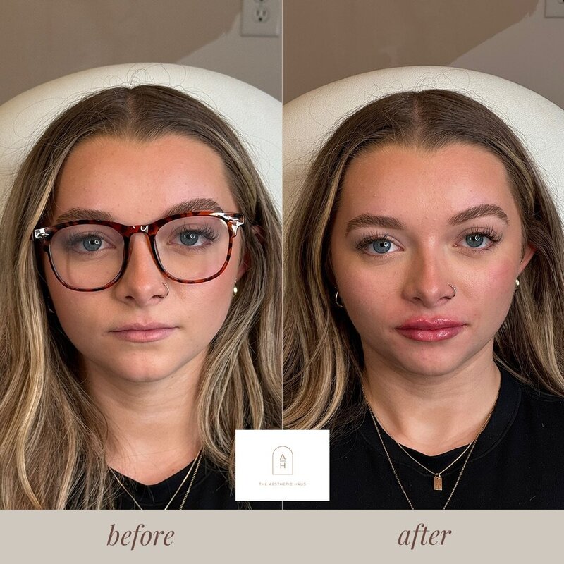 Lip Filler Results High Point