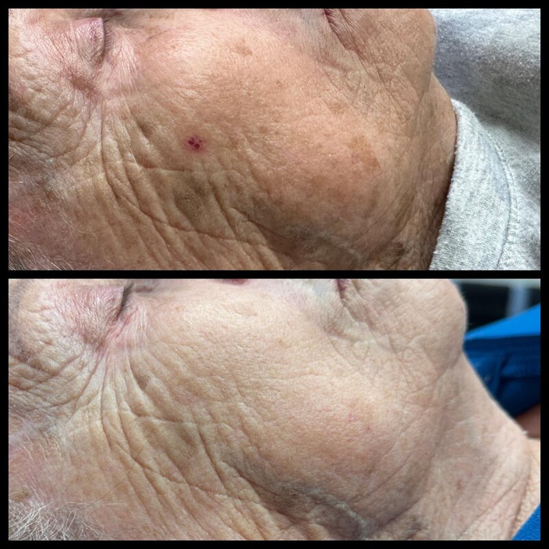 Intense Pulsed Light before and after photo of cheeks