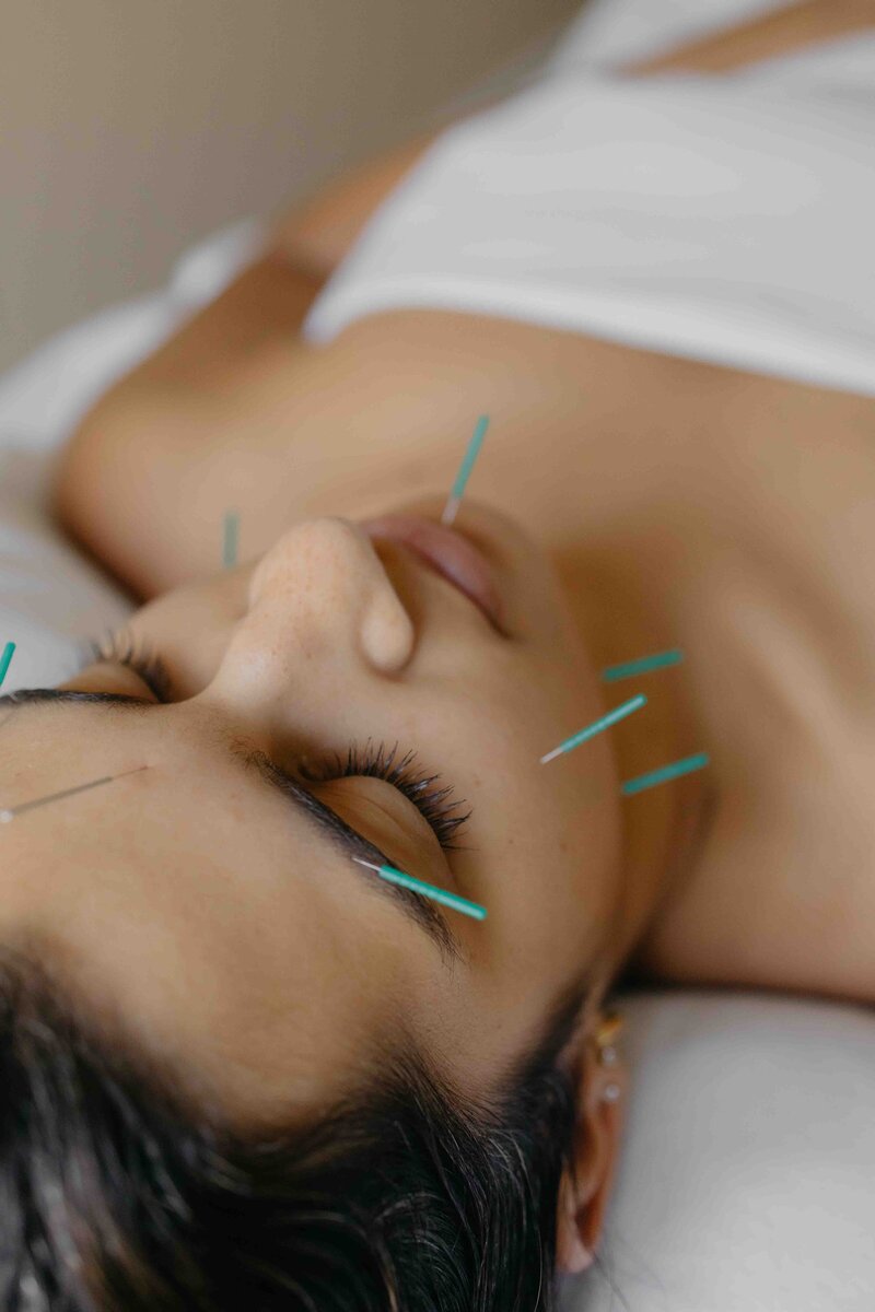 Visage d’une patiente avec plusieurs aiguilles d’acupuncture posées pour un traitement.
