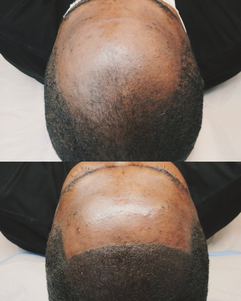Top-down before and after of a man’s scalp micropigmentation—natural hairline and improved scalp density.