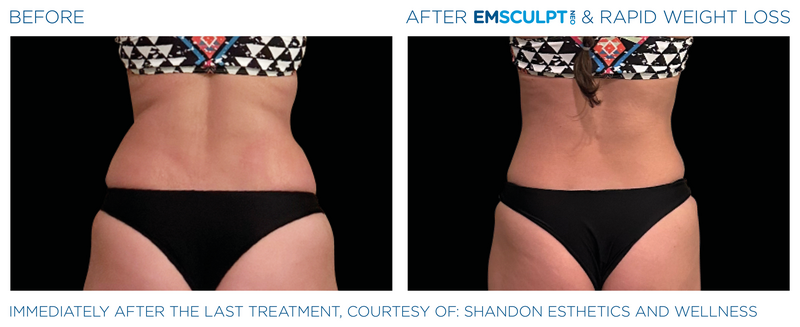 Emsculpt_Neo-Weight-Loss_PIC_Ba-card-female-lateral-abdomen-008_ENUS100