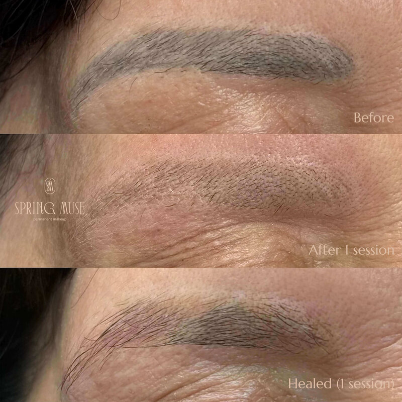 Laser microblading removal NYC