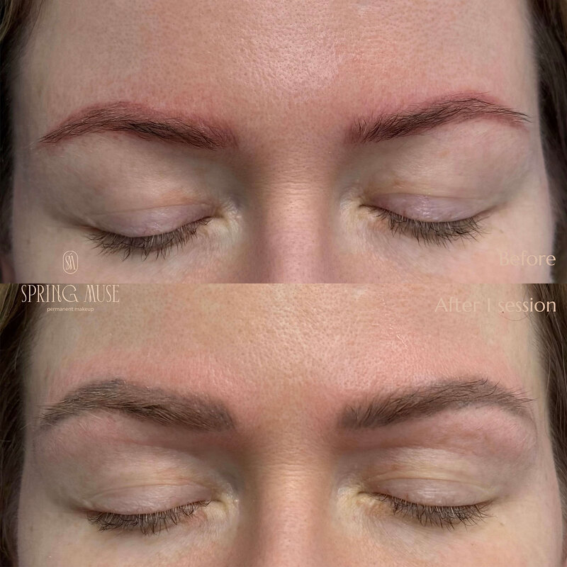 Laser Eyebrows Removal New York