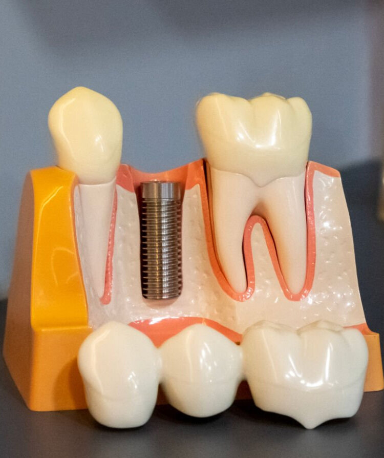 Single Tooth Implant in Lakeway, TX