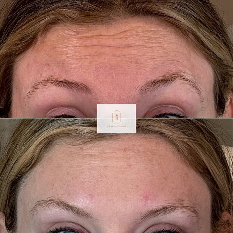 Botox Results Kernersville