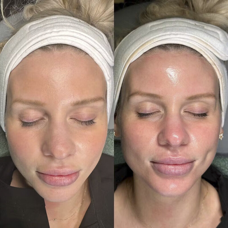 hydrafacial results example