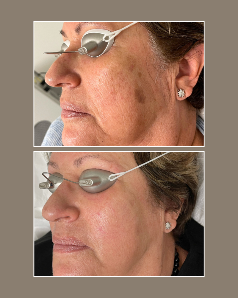 Lasers - Glösense Dermatology and Aesthetics, Miami