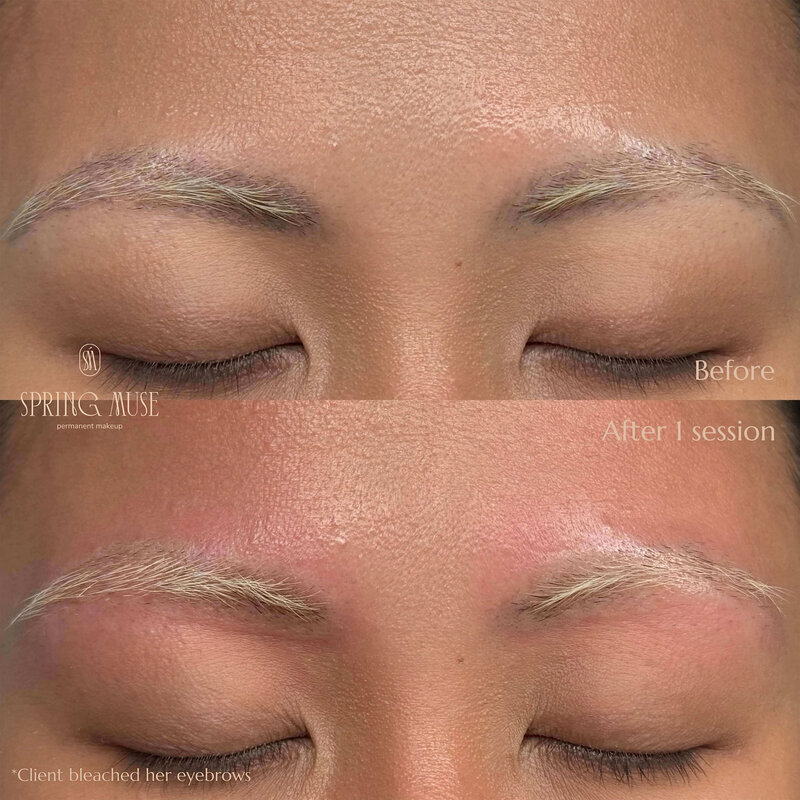 Laser microblading removal New York