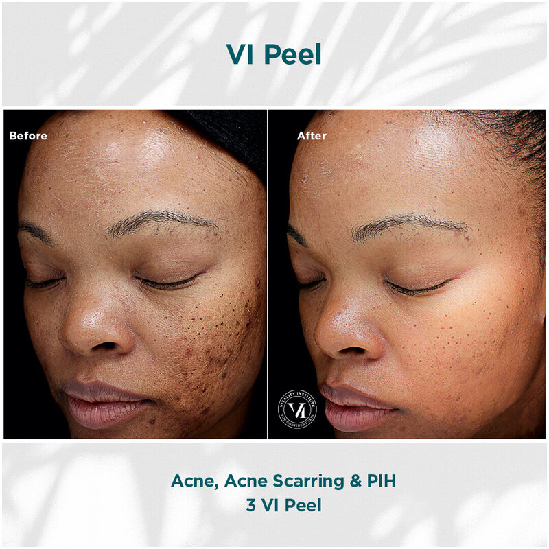 Acne, Scarring _ PIH_01