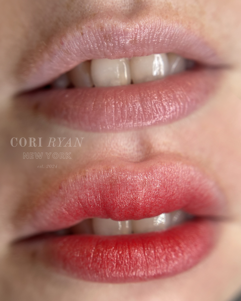 lip neutralization brooklyn