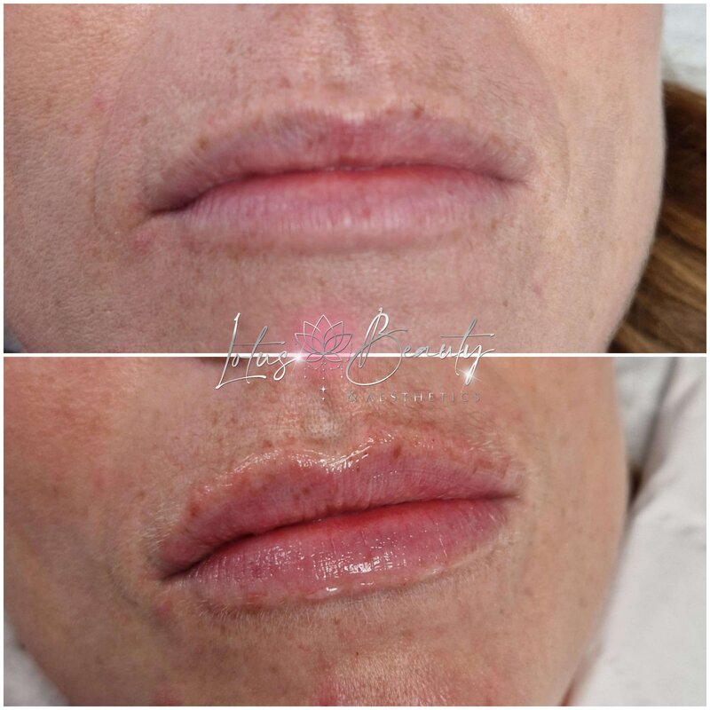 Dermal fillers- client before and after Russian lip fillers