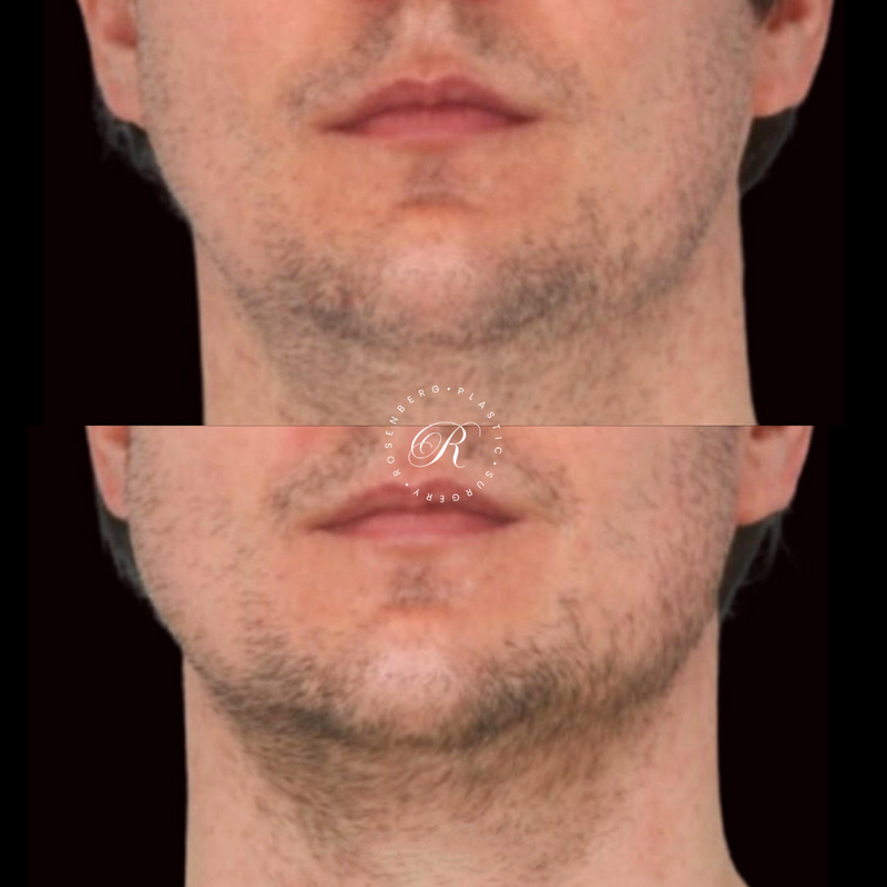 Non-surgical ChinJaw Augmentation RPS Before & After.zip - 52