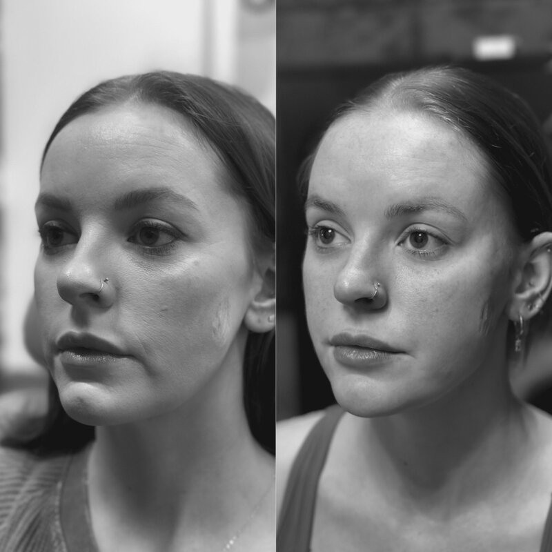 Full facial balancing using dermal fillers by expert injector at Luna Skin, Bryan TX esthetician clinic