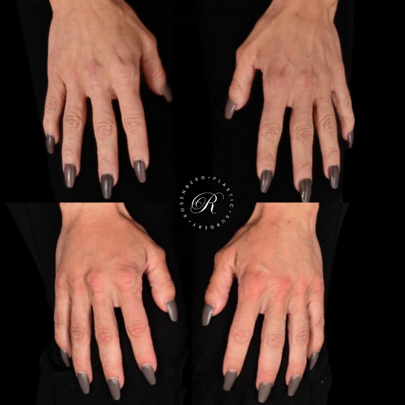 Non-surgical Hand Rejuvenation RPS Before & Afters.png