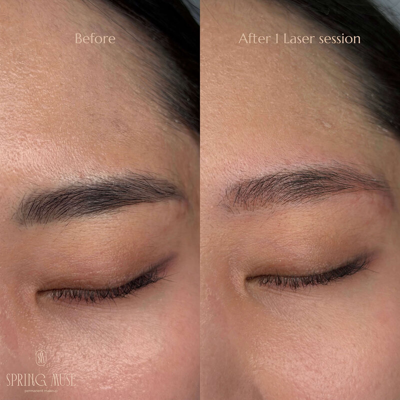 Laser Eyebrows Removal New York