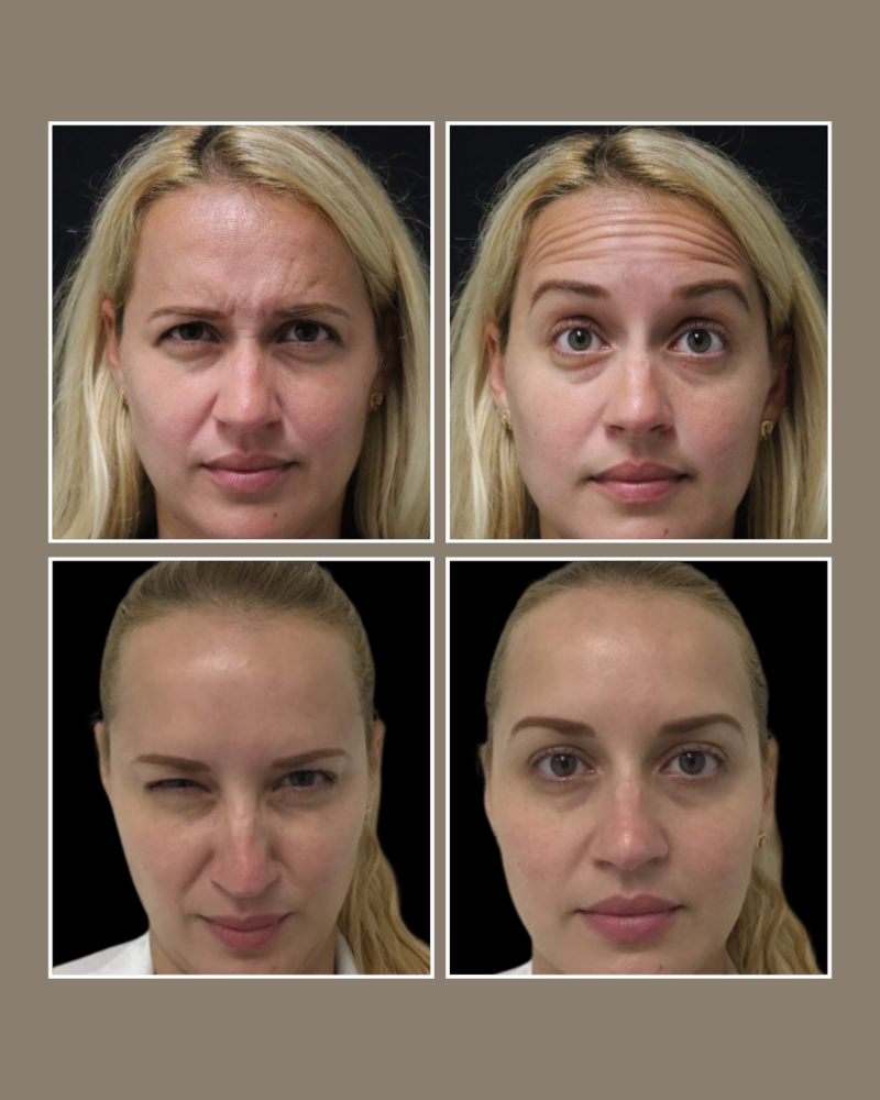 Injectables - Glösense Dermatology and Aesthetics, Miami