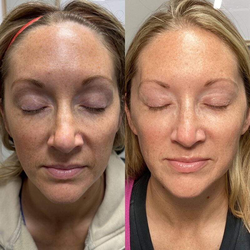 Before and after photos of a woman with Sculptra