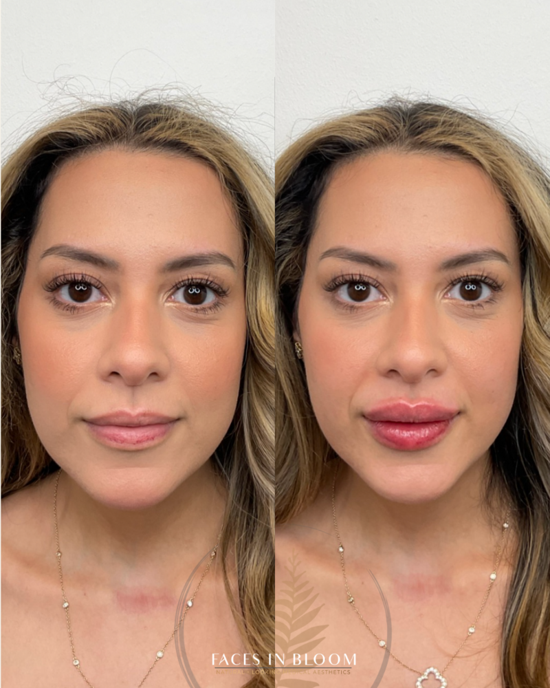 Lip Filler in Vancouver Wa