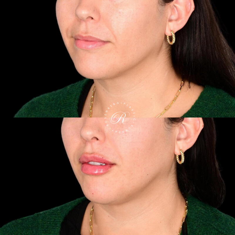 Non-surgical Lip Augmentation RPS Before & Afters.zip - 9