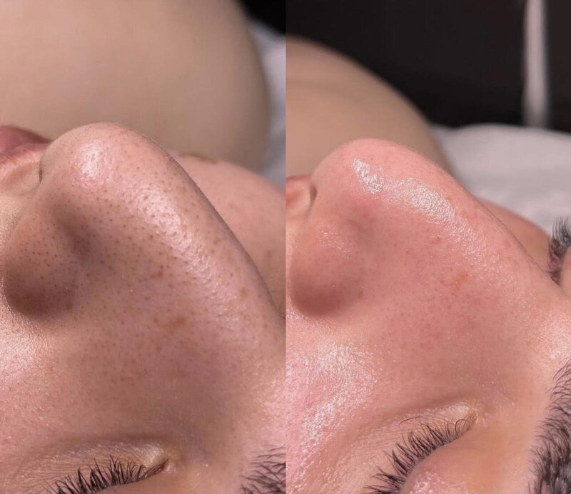 Aqua Facial2