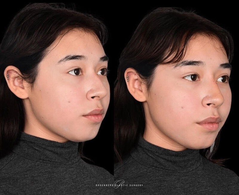 Nose Filler Results