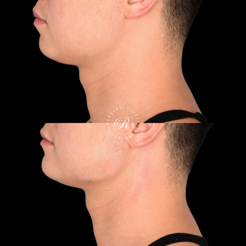 Non-surgical ChinJaw Augmentation RPS Before & After.zip - 43