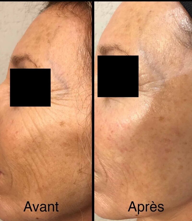 infirmière-esthétique-jet-peel-brignoles