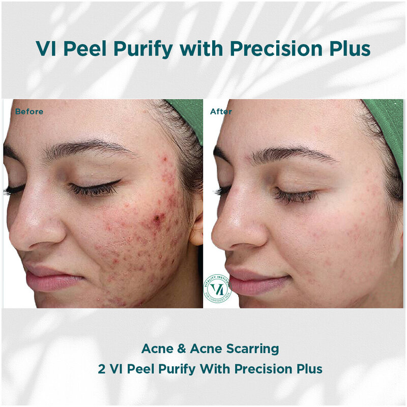 Acne _ Acne Scarring_01