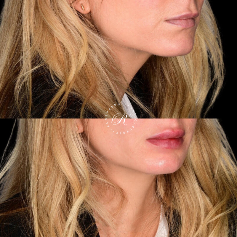 Non-surgical Lip Augmentation RPS Before & Afters.zip - 13