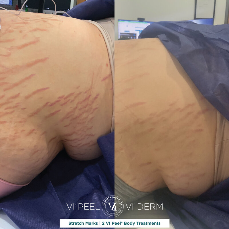 Atranis L_2 VI Peel Body_Stretchmarks on Abdomen_RATING A