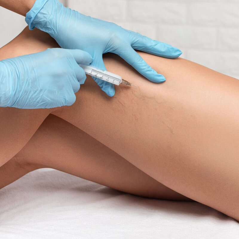 before-and-after-sclerotherapy