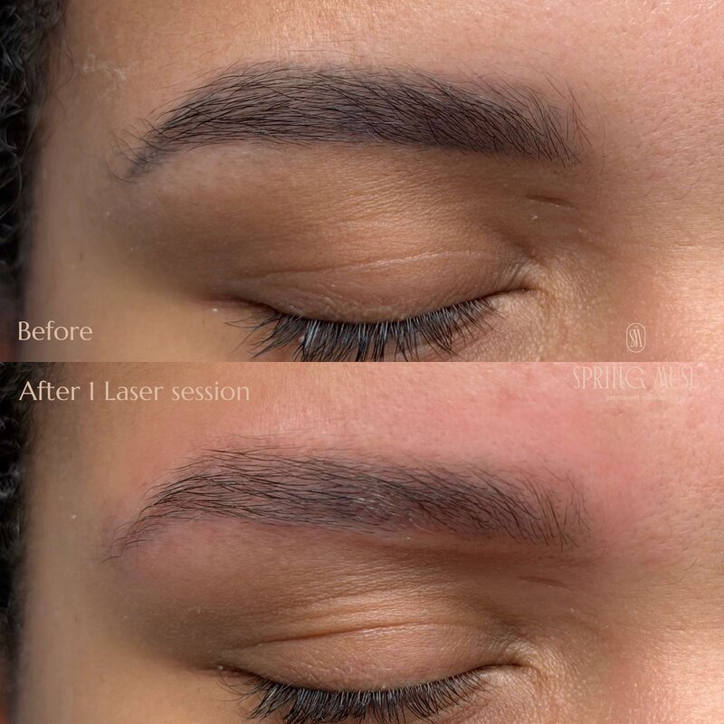 Laser Eyebrows Removal New York