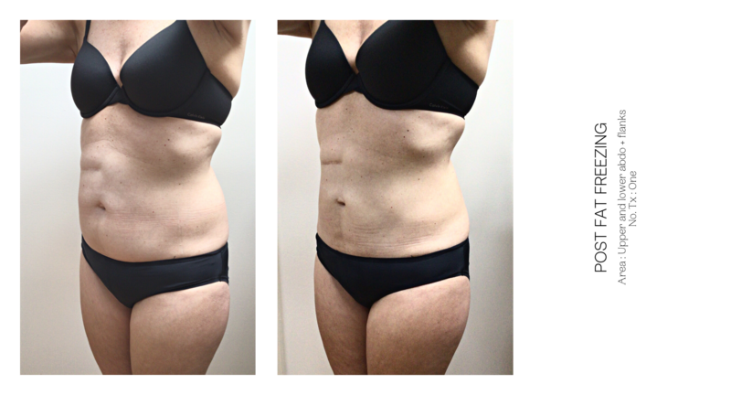 cosmetic treatments for weight loss