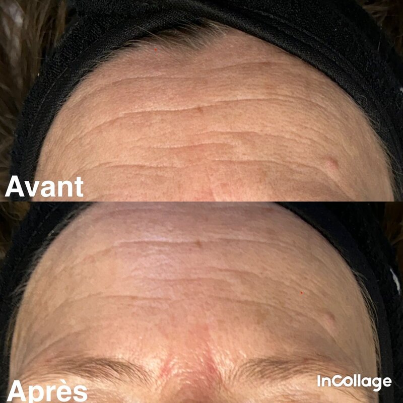avant après du jetpeel