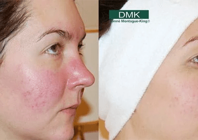 rosacea before and after skincare treatment