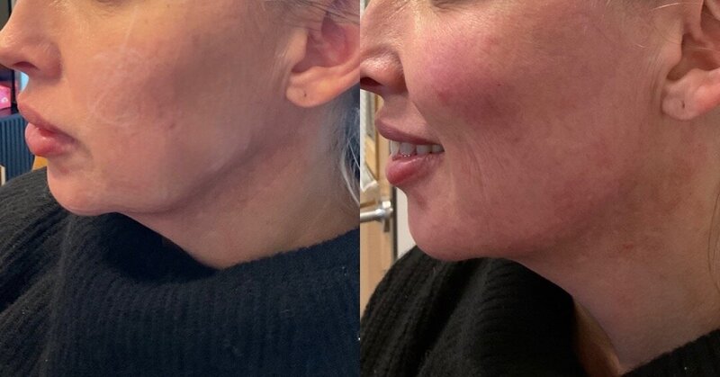 Sculptra after photo